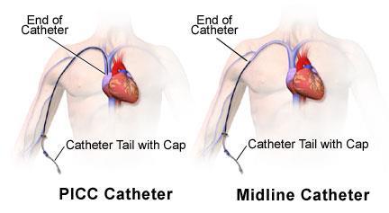 PICC LINES Peripherally Inserted Central Catheter Central Line, inserted in peripheral Upper Extremity Tip terminates at distal (lower) vena cava above the heart.