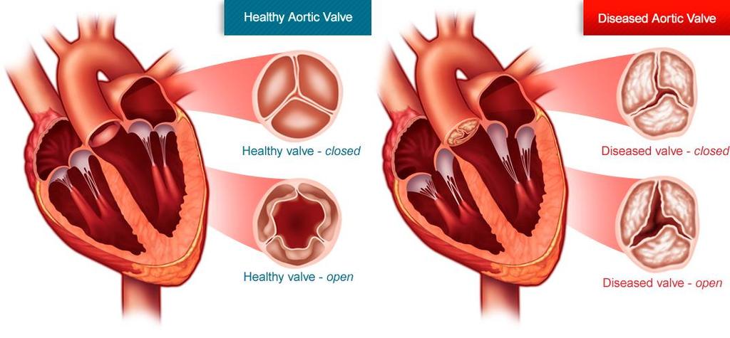 Aortic Stenosis 101: The