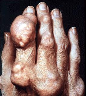 Gout clinics Over 50% >15%/High risk Patients