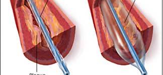 Sequential innovations in catheter-based treatment for non-acute coronary artery