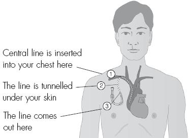 The Hickman Line To begin with, intravenous Flolan is often given into a vein in your hand or arm (via a cannula).