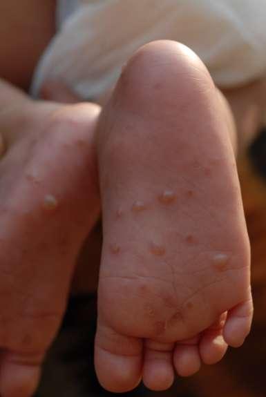 Infant with intact and open pustules covering body