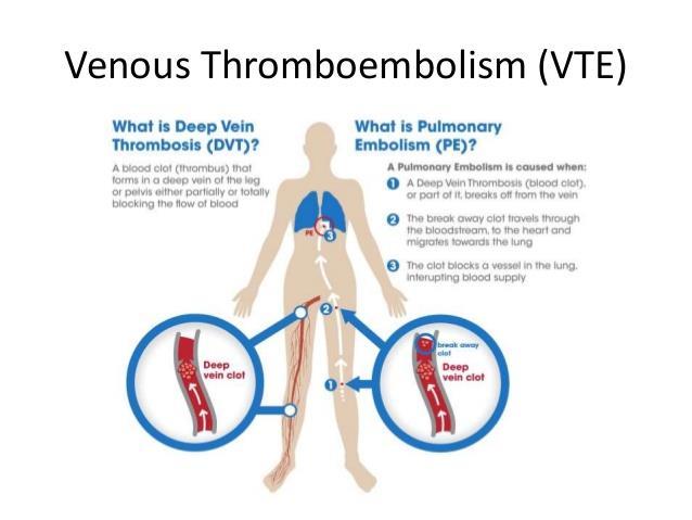Venous Thromboembolism (VTE) Screen for risk of VTE