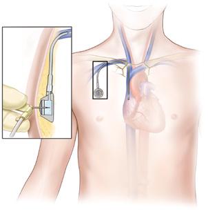 INSERTION SITE VEIN CUFF KEEPS TUNNELED CATHETER IN PLACE HEART