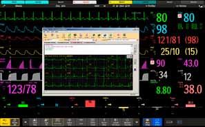 Access previous ECGs from Philips TraceMasterVue or other