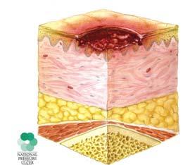Result of surgical intervention Stage I or II pressure ulcer Skin tear is not a healing wound