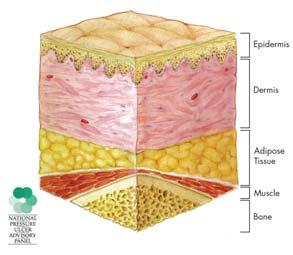 NORMAL SKIN Source: National Pressure Ulcer Advisory Panel at www.npuap.