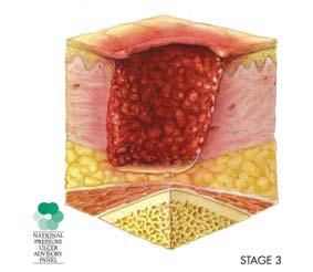 STAGE III Open, sunken hole called a crater Damage to tissue below the skin Source: National Institutes of Health 67 STAGE IV Damage to the muscle and bone Source: National