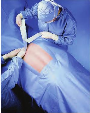 Sterile drapes are added around the incision site The draped area is usually larger than the
