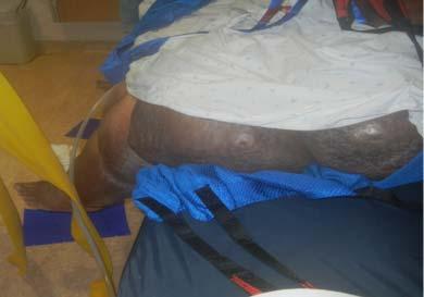 slings to raise patient up in supine and turned 90 degrees to edge of bed with another mesh