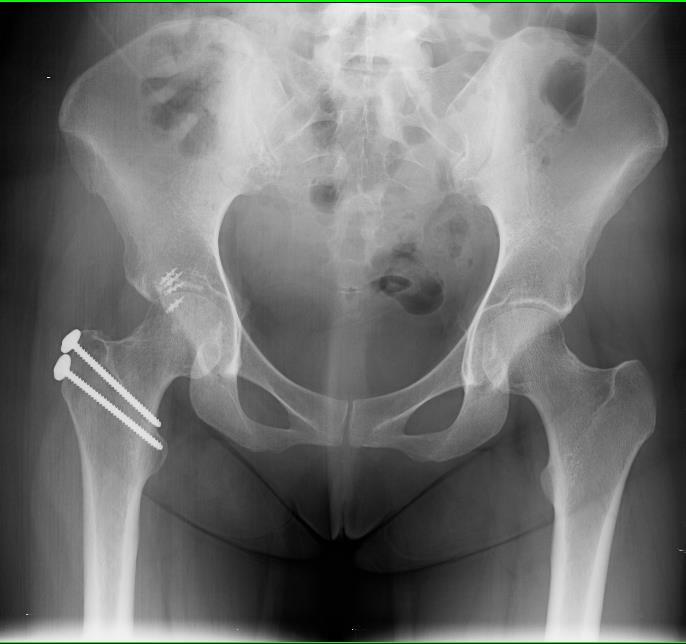 SURGICAL HIP DISLOCATION QUESTION AND ANSWERS ABOUT RECOVERY AFTER SURGERY Follow-up appointment: 4 weeks foot flat weight-bearing status 8 weeks foot flat weight-bearing status After your surgical