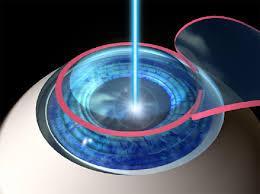 SBIR: The Lasik Story Technology originally developed through several NASA and DOD SBIR contracts for laser guided docking of space vehicles to satellites.