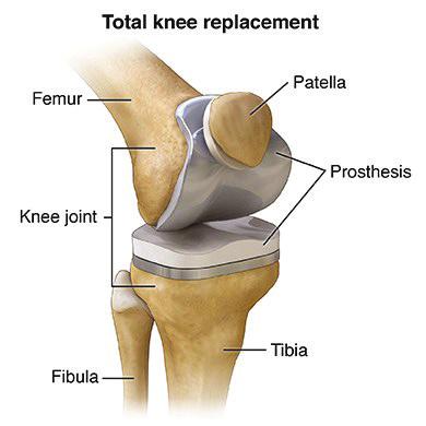 What is Joint Replacement Total join replacement is a surgical procedure in which parts of an arthritic or damaged joint are removed and replaced with a metal, plastic or ceramic device called a