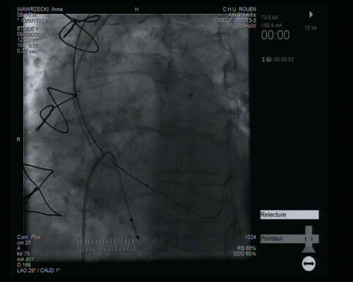 Each procedural step matters Ballon pre-dilatation -Crossing the valve; wire selection and preshaping -Balloon