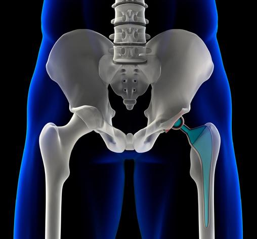 What is Total Hip Replacement Surgery? Your hip is made of two basic parts that move and work together to ensure smooth motion and function.