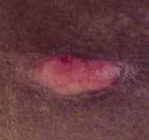 SPECIAL ARTICLE Implications of Pressure Ulcers and Its Relation to Federal Tag 314 Courtney H.