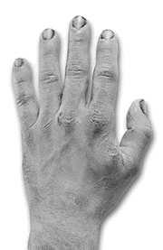 5 Hand Care 5.1 In order to achieve effective hand hygiene, it is important to look after the skin and fingernails (Infection Control Nurse Association 2002). Damaged or dry skin (see picture 1.