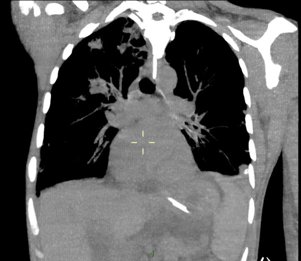 Case 4 42 year old man History of intra-venous drug use Admitted to ITU with tricuspid valve