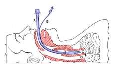 Endotracheal Tube Placement of an endotracheal tube is called intubation. A flexible plastic tube is inserted into your trachea through the mouth.
