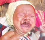 A very unhappy mother came to Okhaldhunga hospital five years ago. Her child had a cleft lip and palate, and even his hands and feet were malformed. After delivery, the father was scared and ran away.