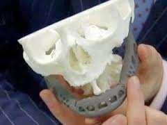 New Advances Clavicle Cranium 3D implants for complex orthopaedic and facial reconstruction