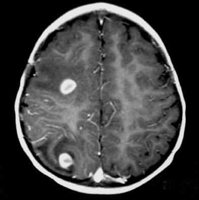 Neurocysticercosis How this disease is acquired? By ingestion of Taenia solium eggs Mark /3 /3 Mention three differential diagnoses? 1. Tuberculomas 2. Toxoplasmosis /3 3.