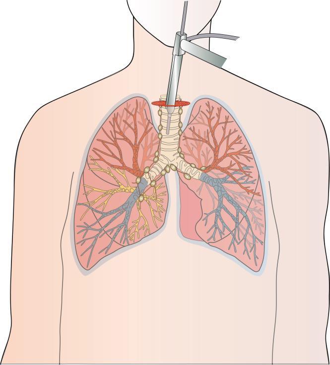 Thoracic Surgery Unit Information for Patients Having an Examination of the Lymph Glands Inside the Chest Cervical Mediastinoscopy (often simply Mediastinoscopy ) The following information has been