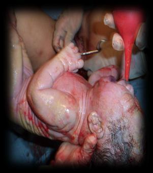 cord cutting and delayed drying expose newborns to: delayed fetal