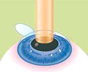 8 Refractive Eye Surgery KCE Report 215Cs Figure 1 Illustration of laser and phakic intraocular