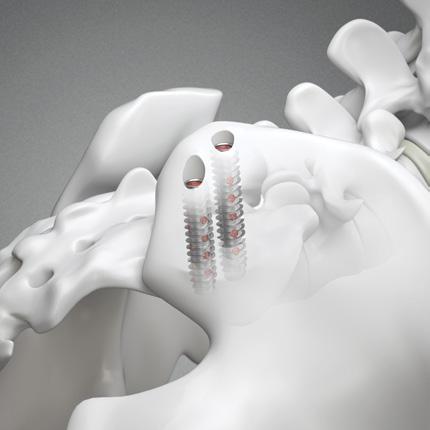 Indications for Use The Rialto SI Fusion System is intended for Sacroiliac Joint fusion for conditions including Sacroiliac Joint disruptions and degenerative sacroiliitis.