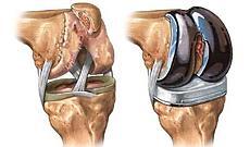 Loss of Choice & Competition Will Lead to Higher Costs Knee Joint Replacement Consumer Share of