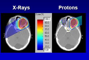 Bringing Proton Beam Therapy to UCLH PBT is one of the most advanced and effective forms of radiotherapy in the