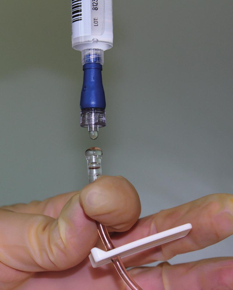 Detach the empty sodium chloride syringe while leaving the new needleless connector attached. 8.