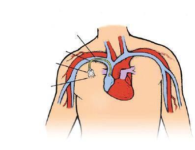 The catheter is in a large vein with the tip ending right outside the heart.