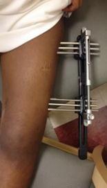 EXTERNAL FIXATOR Used to immobilize a bone such as a thigh, arm,
