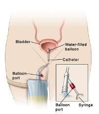 FOLEY CATHETER A tube inserted into the bladder