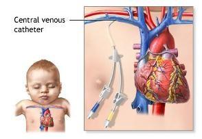 CENTRAL VENOUS CATHETER (CVC) An intravenous line surgically placed in a large vein in the