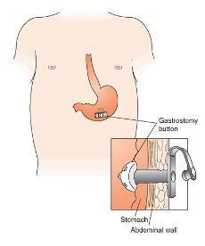 GASTROSTOMY BUTTON (GT) A feeding tube surgically
