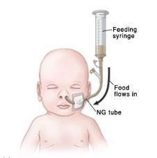 NASOGASTRIC TUBE (NG) A tube inserted in the nose