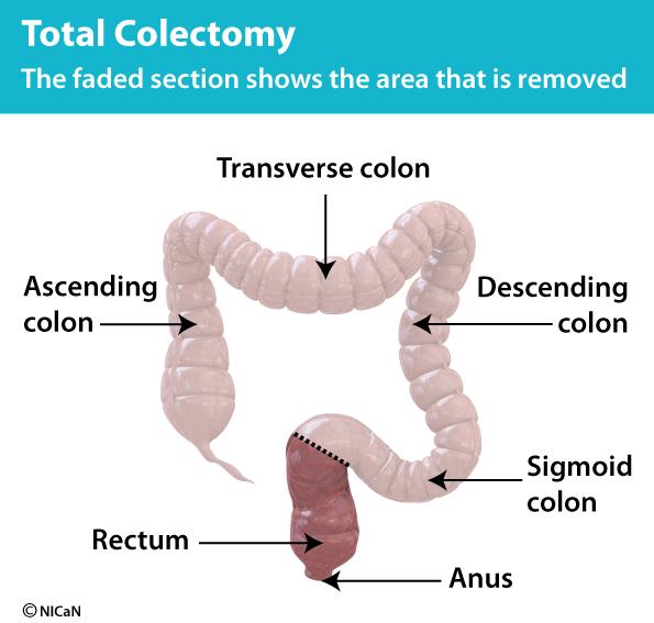 Information to help you make your decision What is a Total Colectomy? It is an operation to remove the colon. The rectum and anus are left intact.