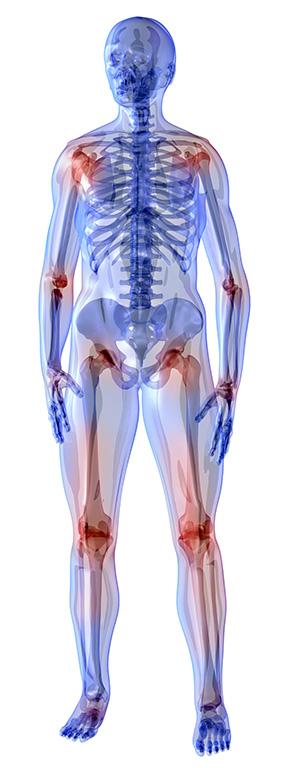 OSTEOARTHRITIS Slow developing joint pain Stiffness, bony enlargement One or both sides affected Usual onset is middle age RHEUMATOID ARTHRITIS Symptoms come and go Affects all ages Chronic systemic