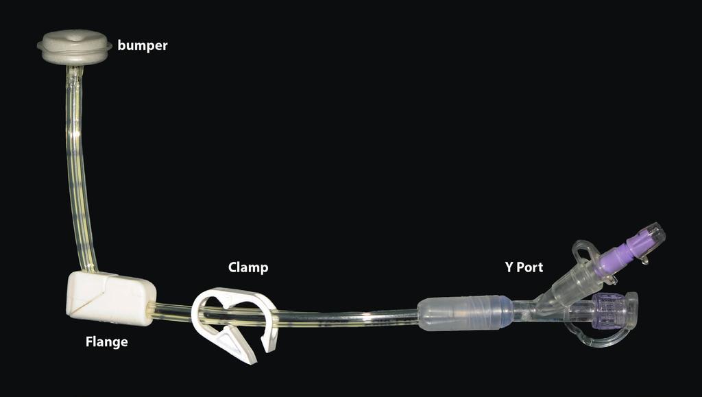 What does a PEG look like? How is the PEG inserted? The day of the procedure: You will be admitted into hospital.