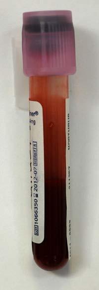 Specimen Collection If it is determined that testing for Ebola virus is indicated At least 4 ml of whole blood collected in a