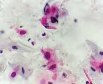 Picture 4 Microscopic: Invasion and perineural expansion of the tumour (adenocarcinoma) of the gallbladder (enlarged 40x) Pictures 5 An example of