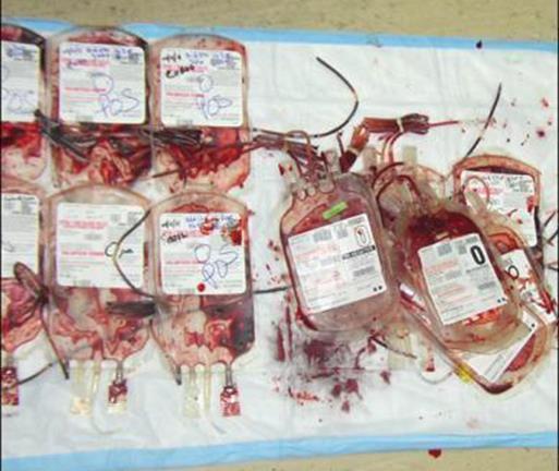 Updates in Blood Transfusion Strategies /