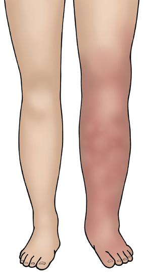 Signs and symptoms of VTE DVT - Symptoms can include swelling, redness/ discolouration, warmth and tenderness/pain that may be worse when standing or walking.