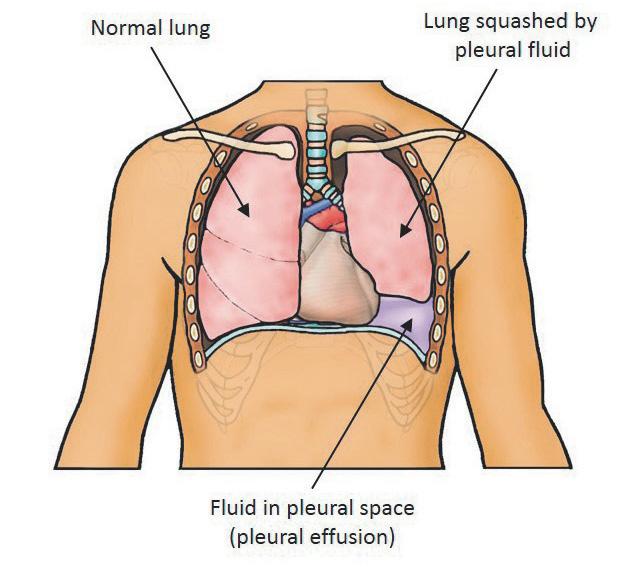 What is a medical thoracoscopy? Fluid has formed in the space between your lung and the chest wall (pleural space).
