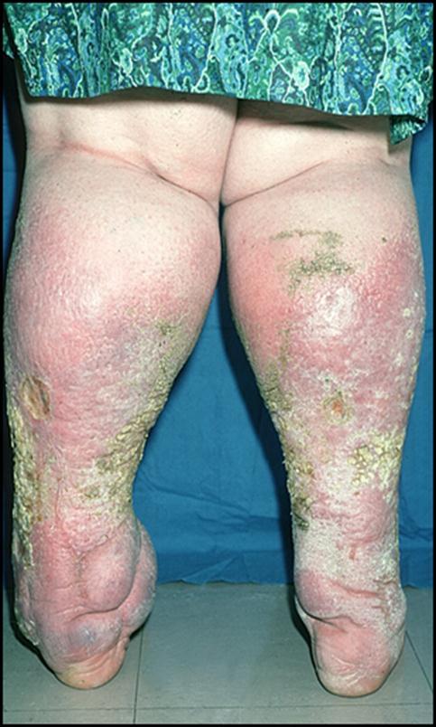 Photograph courtesy of Christine Moffatt Patients with leg ulcers