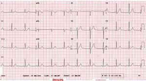 42 year old father presents to an emergency department after falling out at home without any warning Normal EKG; one week
