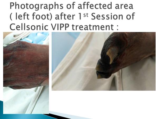 session of cellsonic VIPP treatment Figure 4.